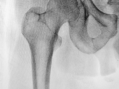 Synthetic Bone Set to Reimagine Genetic Disease Therapeutics