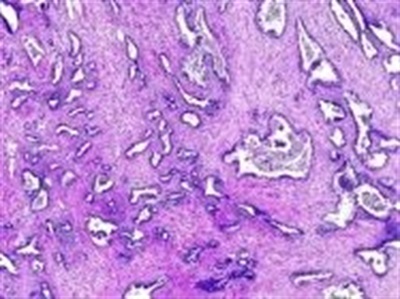 Researchers Develop Micro-fluidic Probe to Isolate Cancer-spreading Cells