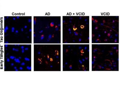 Novel Target Shows Promise in Treating Alzheimer's