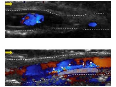 Imaging Method to Detect Deep Vein Thrombosis May Also Treat It