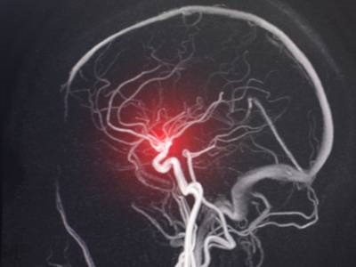 New Cell Atlas of Brain Vasculature Reveals Stroke Insights