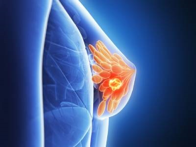 EV Integrins Could Aid Early Diagnosis of Breast Cancer Metastasis