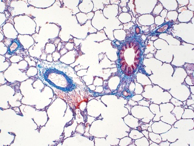 Researchers Debut Largest Cell Map of the Human Lung