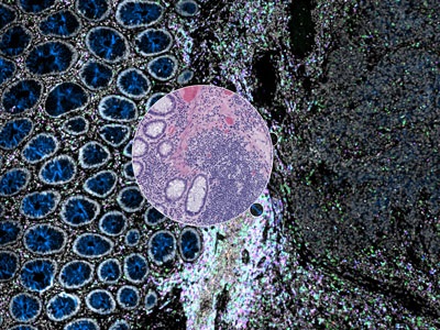 Groundbreaking New Cancer Diagnostic Tool