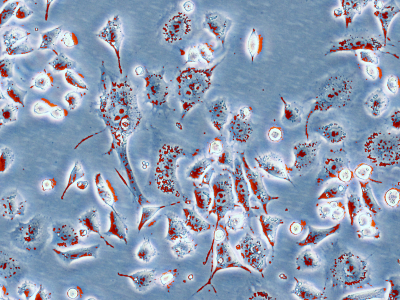Researchers Discover Potential Pancreatic Ductal Adenocarcinoma Treatment