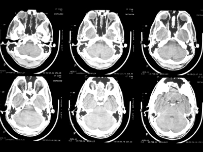 Optogenetics Shows Promise As An Epilepsy Treatment By Controlling Brain Seizure Activity