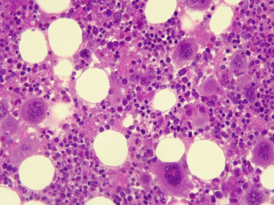 Universal Diamond-Blackfan Anemia Gene Therapy Ready For Clinical Trials