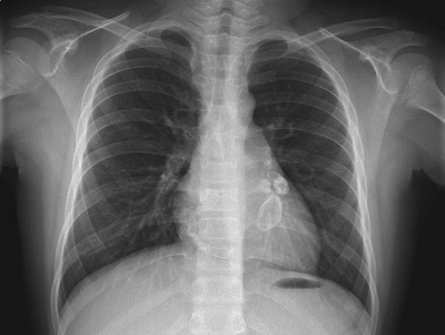 Public Health Agencies Issue Alerts on Fatal Pediatric Illness Related to COVID-19