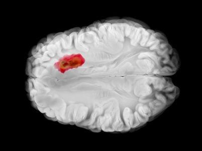 Team Finds Way to Slow Glioblastoma, and HIV Medication that Could Help