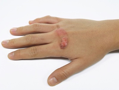 Burn Injuries may Have Played Key Role in Human Evolution