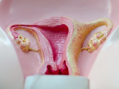 Experts Rename PCOS to Reflect Multisystem Disease