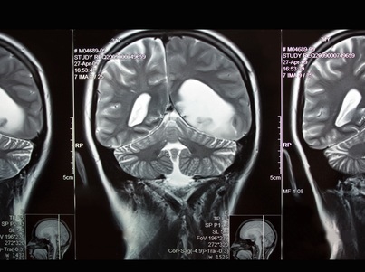 AI Uncovers Hidden Brain Lesions in MS Patients