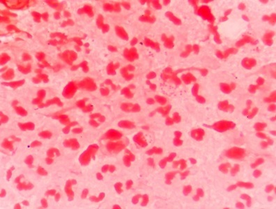 Drug-resistant Gonorrhea on the Rise in Europe