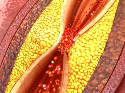  'Triple-threat' Immune Cells Target Plaque Behind Heart Attacks, Strokes