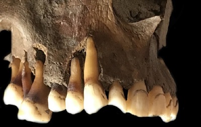 Ancient DNA Says Bronze Age Kissing is Responsible for Today’s Herpes Strain