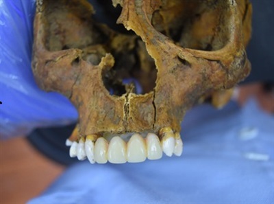 Philippine's Forensic Dentist Turns to Teeth for Disaster Victim Identification